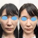 【女性】 蘇原しのぶ院長オリジナル鼻ヒアルロン酸 before画像 サムネイル用