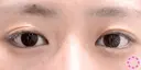 ♡二重埋没法 before画像 サムネイル用