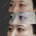 経結膜脱脂術 before画像 サムネイル用