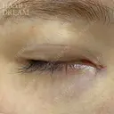 ドリームダブル・目頭切開 after画像 サムネイル用