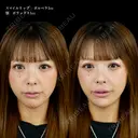 スマイルリップ（ボルベラ）アゴ（ボラックス） before画像 サムネイル用