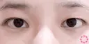 二重埋没法 before画像 サムネイル用