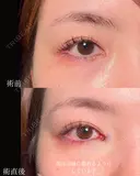 目頭切開 before画像 サムネイル用
