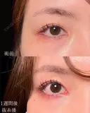 目頭切開 7日後 サムネイル用