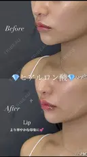 【リップ】ヒアルロン酸注入 after画像 サムネイル用