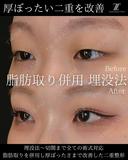 脂肪取り併用　埋没法 after画像 サムネイル用