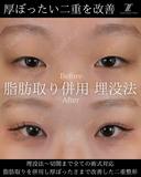 脂肪取り併用　埋没法 after画像 サムネイル用