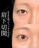 🧡眉下切開(切開リフト)🧡 before画像 サムネイル用