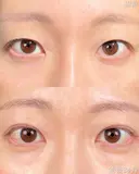 🧡眉下切開(切開リフト)🧡 90日後 サムネイル用
