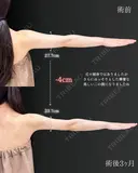 【二の腕】の脂肪吸引🧡 after画像 サムネイル用