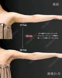 【二の腕】の脂肪吸引🧡 after画像 サムネイル用