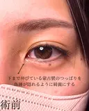 目頭切開 before画像 サムネイル用