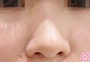 小鼻縮小　鼻翼（切開） before画像 サムネイル用