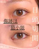 目頭切開 after画像 サムネイル用
