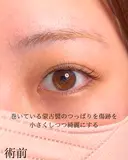 目頭切開 before画像 サムネイル用
