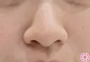 小鼻縮小　鼻翼（切開） before画像 サムネイル用