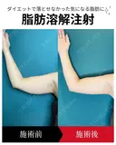 脂肪溶解注射 30日後 サムネイル用