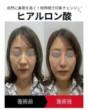 ヒアルロン酸注入 before画像 サムネイル用