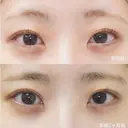 二重埋没法 before画像 サムネイル用