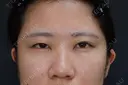 プレミアムクイック埋没法 before画像 サムネイル用