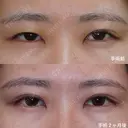 プレミアムクイック埋没法 after画像 サムネイル用
