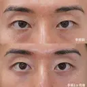 経結膜脱脂＋眼窩脂肪注入 60日後 サムネイル用