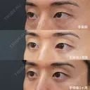経結膜脱脂＋眼窩脂肪注入 before画像 サムネイル用