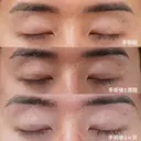 二重埋没　プレミアムクイック法 before画像 サムネイル用