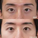 二重埋没　プレミアムクイック法 30日後 サムネイル用