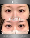目頭切開、二重（自然癒着法）、ヒアルロン酸（涙袋） before画像 サムネイル用