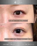 目頭切開、二重（自然癒着法）、ヒアルロン酸（涙袋） 365日後 サムネイル用