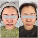 ヴェルベットスキン before画像 サムネイル用