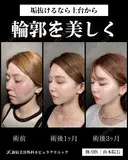 山本医師による🎀小顔脂肪吸引🎀 before画像 サムネイル用