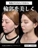 山本医師による🎀小顔脂肪吸引🎀 after画像 サムネイル用