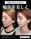 山本医師による🎀小顔脂肪吸引🎀 after画像 サムネイル用