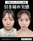 山本医師による🎀小顔脂肪吸引🎀 before画像 サムネイル用