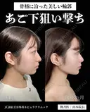 山本医師による🎀小顔脂肪吸引🎀 after画像 サムネイル用