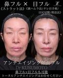 鼻フル28万〜 before画像 サムネイル用