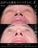 鼻フル28万〜 after画像 サムネイル用