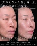 鼻フル28万〜 after画像 サムネイル用