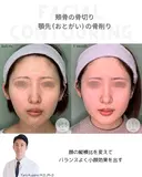 ほほ（頬骨）骨切り&顎先（おとがい）骨削り before画像 サムネイル用