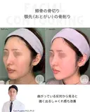 ほほ（頬骨）骨切り&顎先（おとがい）骨削り 30日後 サムネイル用