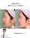 ほほ（頬骨）骨切り&顎先（おとがい）骨削り 30日後 サムネイル用