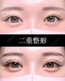 二重埋没法 before画像 サムネイル用