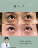 裏ハムラ 90日後 サムネイル用