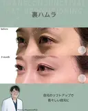裏ハムラ 90日後 サムネイル用