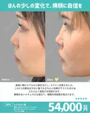 鼻根・顎ヒアルロン酸 before画像 サムネイル用