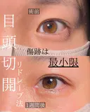 目頭切開 7日後 サムネイル用