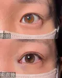 目頭切開 before画像 サムネイル用