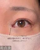 目頭切開 after画像 サムネイル用